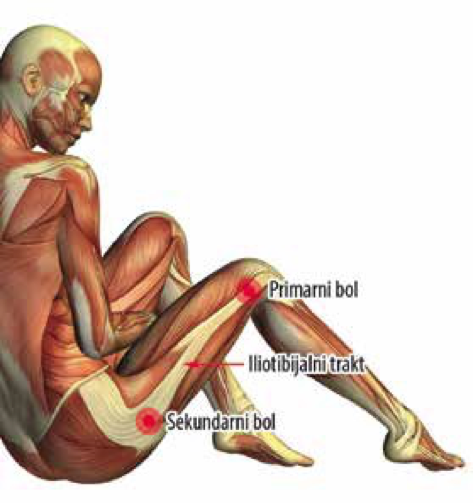 Iliotibijalna traka sa označenim mestima najačeg bola u predelu iznad kolena i spoljašnje strane kuka (slika preuzeta iz knjige Dijagnostka i lečenje bola, autora Branislava Antića)