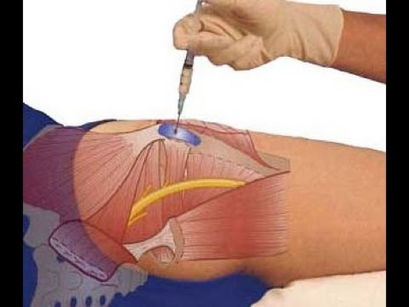 Kortikosteroidna injekcija trohanterične burze na spoljašnjoj strani zgloba kuka
