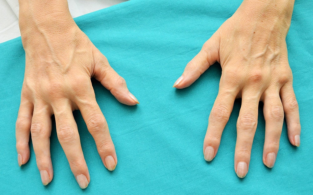 artritis artritis simptomi i liječenje